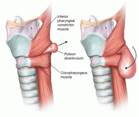 Cricopharyngeal Diverticulum: Open Repair | Thoracic Key