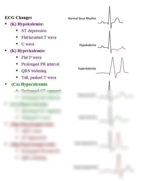 SOLUTION: Ecg changes - Studypool