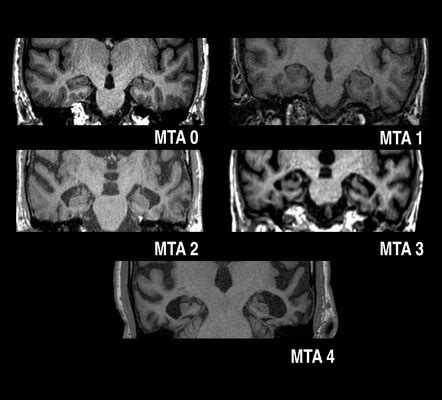 Medial Temporal Lobe Mri