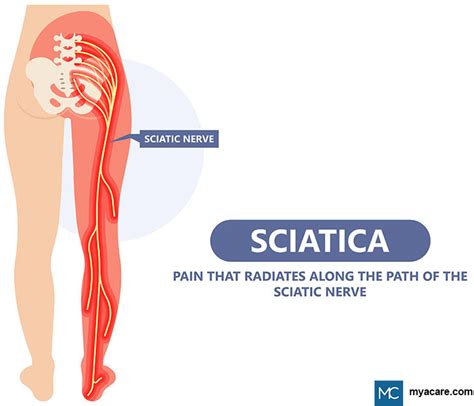 Muscle Weakness In Legs