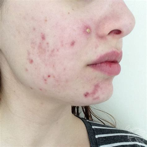 This Girl Developed Severe Cystic Acne That Left Her Face Permanently ...