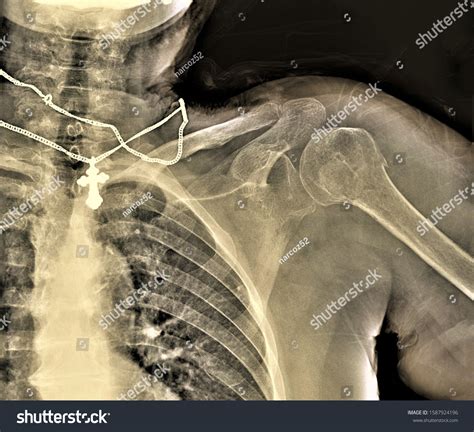 Xray Shoulder Joint Adult Male Fracture Stock Photo 1587924196 ...