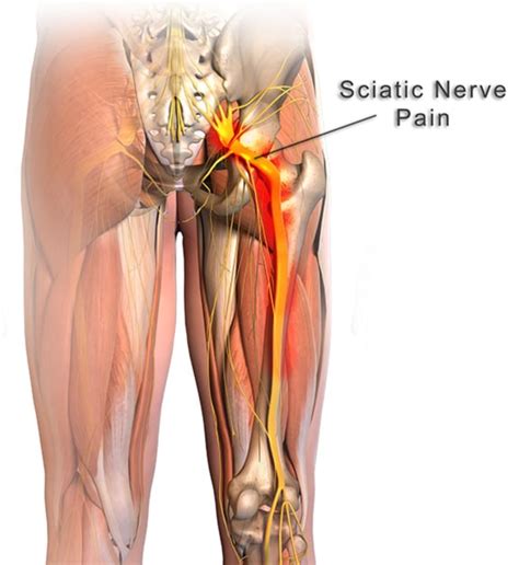 How to Relieve Sciatic Nerve Pain (Do These 9 Odd Exercises) | Yuri Elkaim