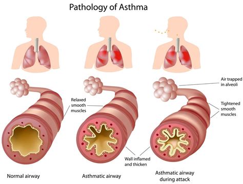 Asthma - Pediatric Pulmonologists