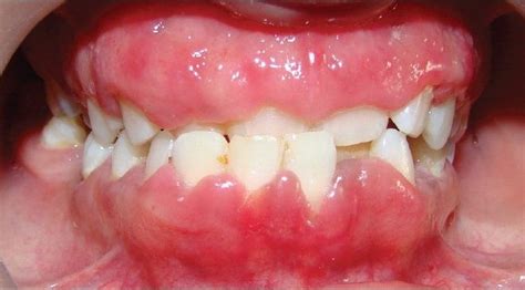 What Causes Swollen Gums? – Humber to Delacalle