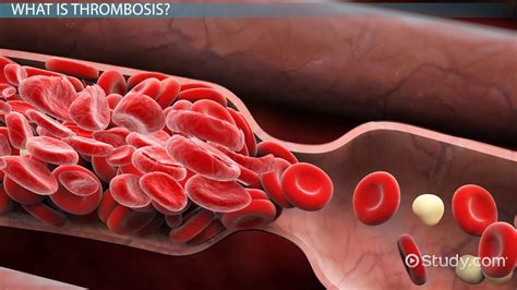 5 Types Of Thrombosis Thrombosis Webmd | Venzero