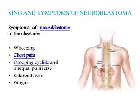 Neuroblastoma: Patient info on symptoms, diagnosis and treatment opti…