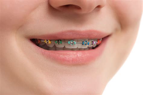 Closeup multicolored Braces on Teeth. Beautiful Female Smile with Self ...