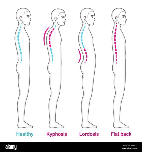 Postural Kyphosis Correction