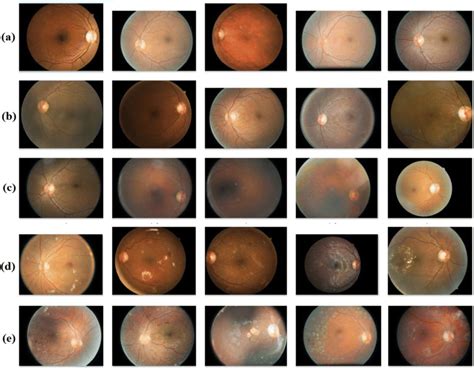 Different stages of Diabetic Retinopathy a) Normal b) Mild c) Moderate ...