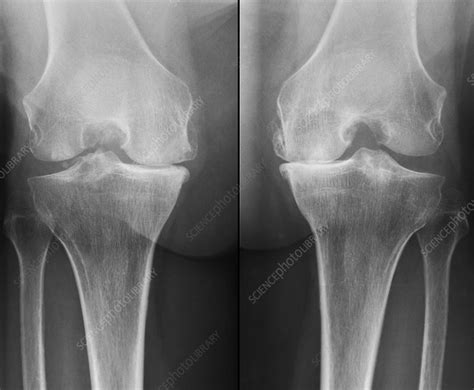 Xray Knee Osteoarthritis