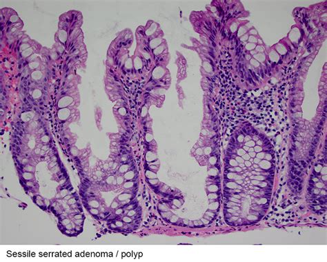 Pathology Outlines - Sessile serrated adenoma