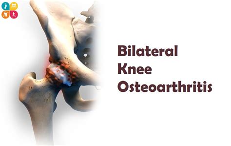 Bilateral Knee Osteoarthritis : Everything That You Wanted To Know ...