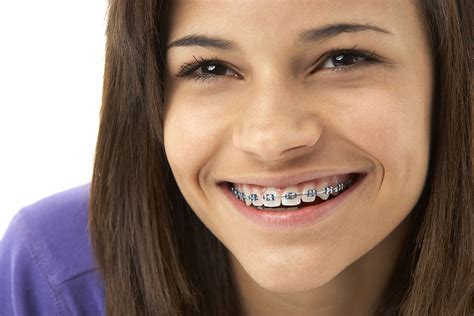 Braces – Straighter Teeth For A Wider Smile – Dr Smile