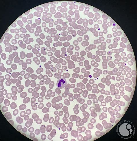 Babesia parasites on peripheral blood smear 3