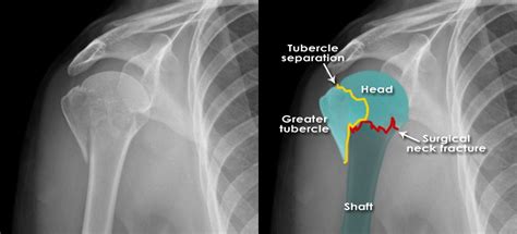 Humerus Anatomic Neck Fracture