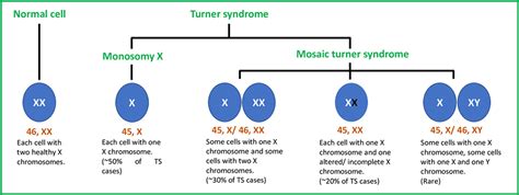 Turner Syndrome: More Than a Missing "X" - myObMD