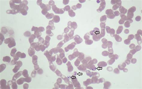 Babesia sp. detected on a blood smear using light microscopy. Arrows ...