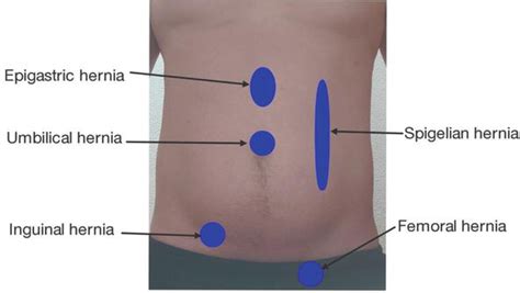 Spigelian Hernia Pictures