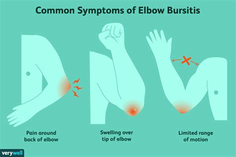 Bursitis des Ellenbogens (Olekranon): Anzeichen und Behandlungen