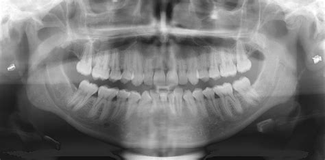 How To Take Bitewing Dental X-Rays : July 28, 2017 may 6, 2019 dental ...