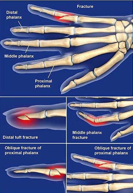 Distal Phalanx Fracture