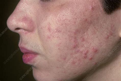 Acne vulgaris - Stock Image - C038/4479 - Science Photo Library