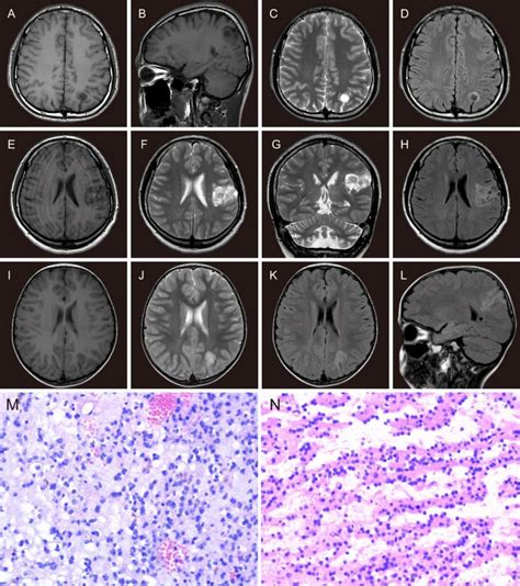 The MRI features and histopathological features of DNTs. The MRI ...