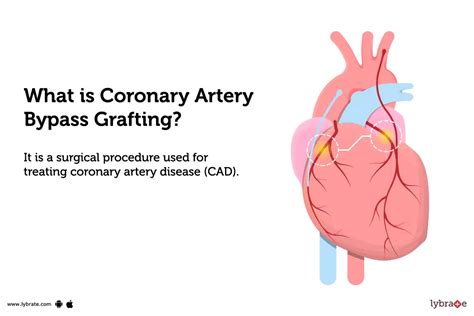 Coronary Artery Bypass Grafting: Purpose, Procedure, Benefits and Side ...