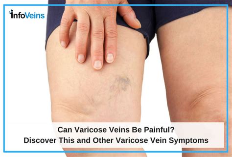 Can Varicose Veins be Painful? | Azura Vascular Care