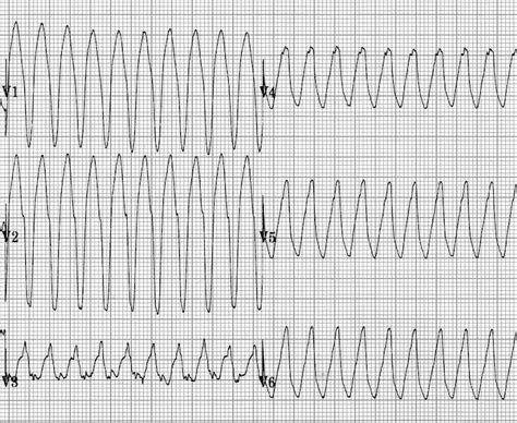 Ventricular Tachycardia Ecg