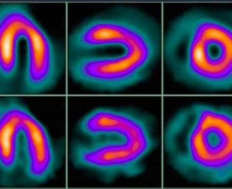 Nuclear Medicine Scan Heart