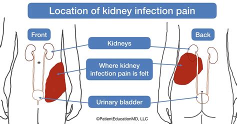 Kidney Pain Location