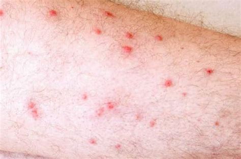 Tiny Red Spots on Skin (Petechiae), What Is This?