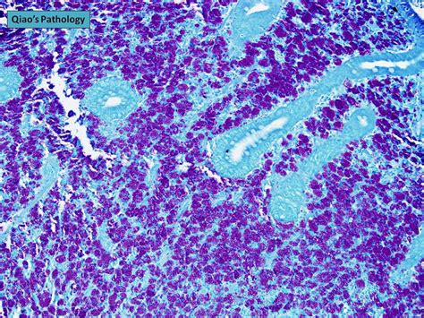 Qiao's Pathology: Disseminated Mycobacterium avium intracellulare ...