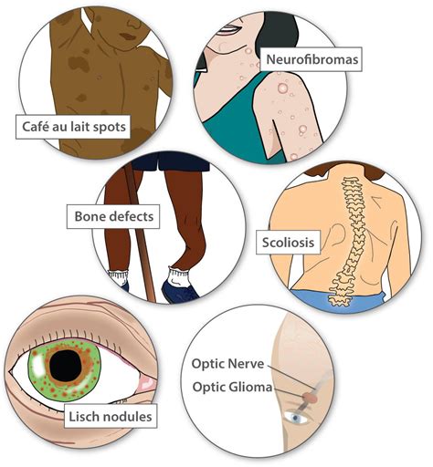 Examples of Single Gene Disorders