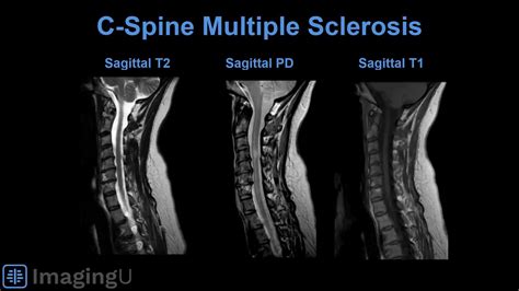 Cervical Spine Mri Ms