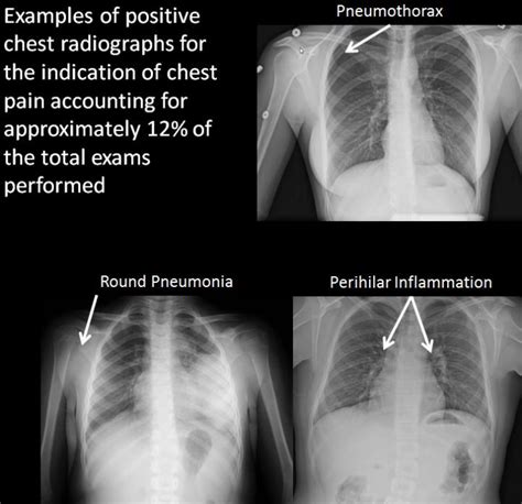 Many chest X-rays in children are unnecessary | EurekAlert!