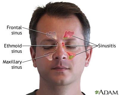 Sinus Infection (Sinusitis) - Symptoms and Causes | Penn Medicine