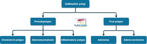 Gallbladder Polyp: Symptoms, Cause, Size, Treatment & Surgery