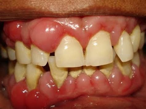 Swollen Gums - Symptoms, Causes, Treatment, Pictures