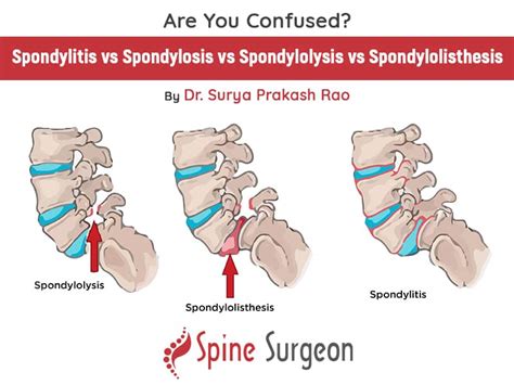 Spondylolysis Vs Spondylolisthesis