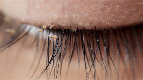 Doctors warn about lash lice becoming more common in eyelash extensions ...