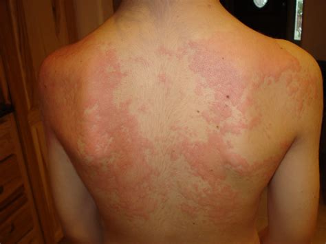 Pics Photos - Hives From An Allergic Reaction