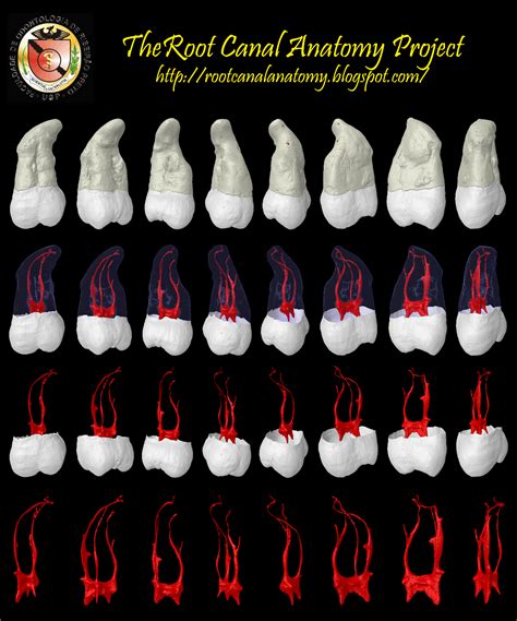 The Root Canal Anatomy Project: Maxillary Third Molar