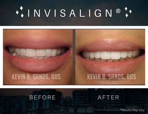 Invisalign Vs Braces Results