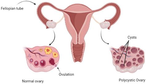 Normal Vs Polycystic Ovaries Ultrasound