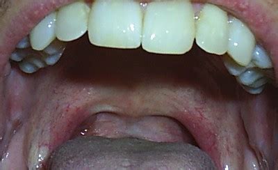 non-uvula | I had my uvula removed a couple years ago. Peopl… | Flickr