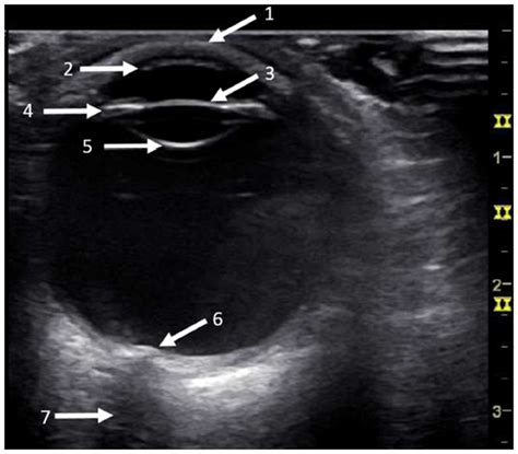 Ocular Ultrasound of a normal eye. The ultrasound probe is applied to ...