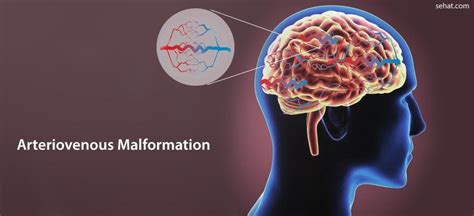 (AVM) Arteriovenous Malformation Surgery - Costs, Health Benefits And Risks